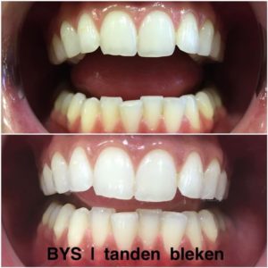 Tandenbleken_Janitte
